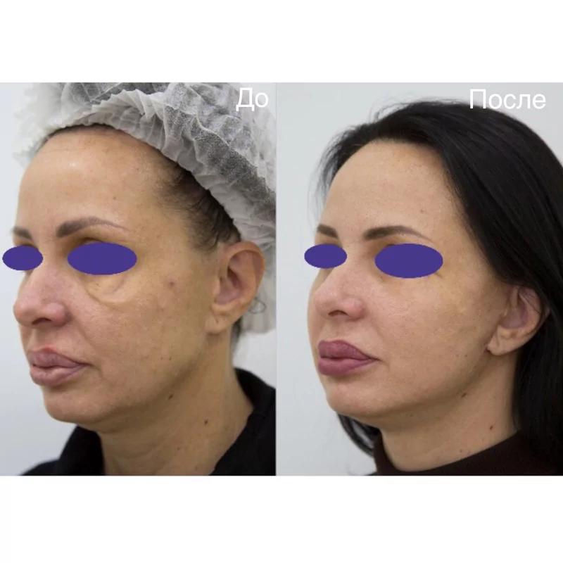 Фотография до и после с проведенной операции Фейслифтинг в Волгограде в клинике Олимп