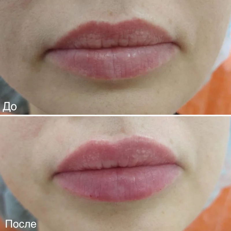 Фотография до и после с проведенной процедуры контурная пластика губ в Волгограде в клинике Олимп