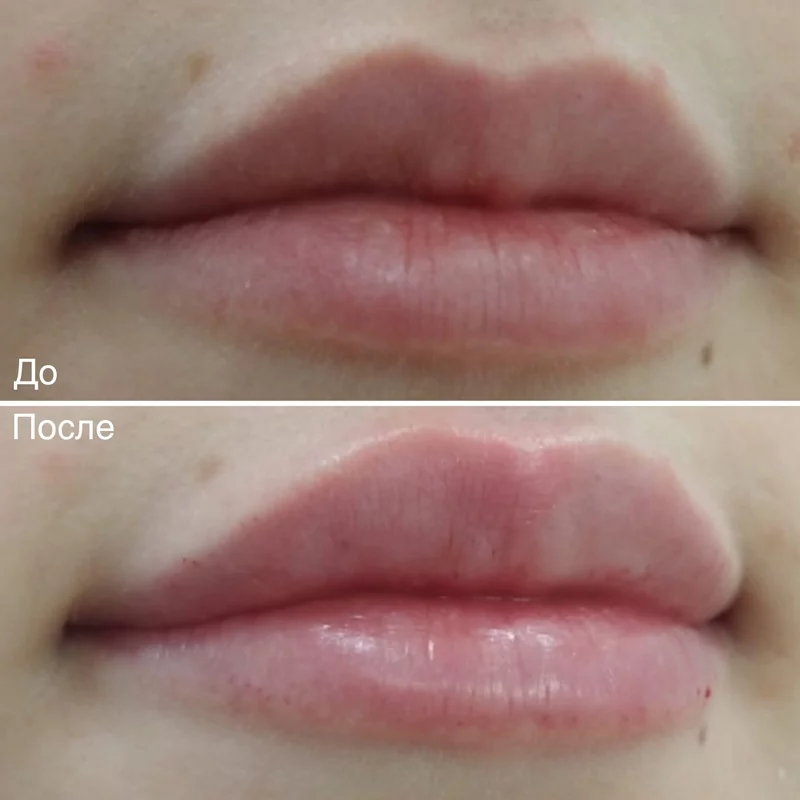 Фотография до и после с проведенной процедуры контурная пластика губ в Волгограде в клинике Олимп