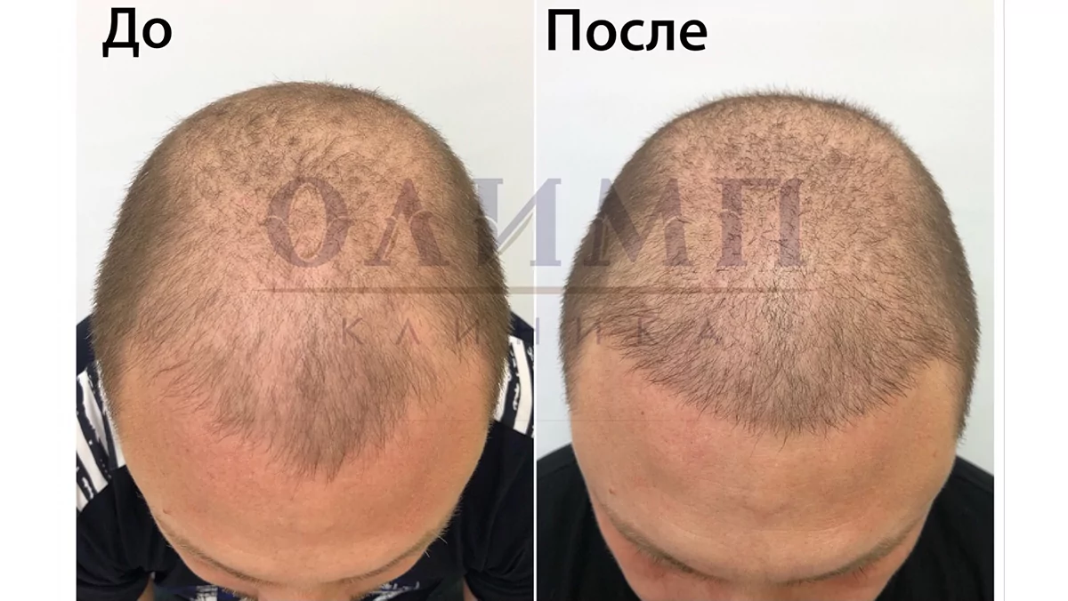 пересадка волос в Волгограде