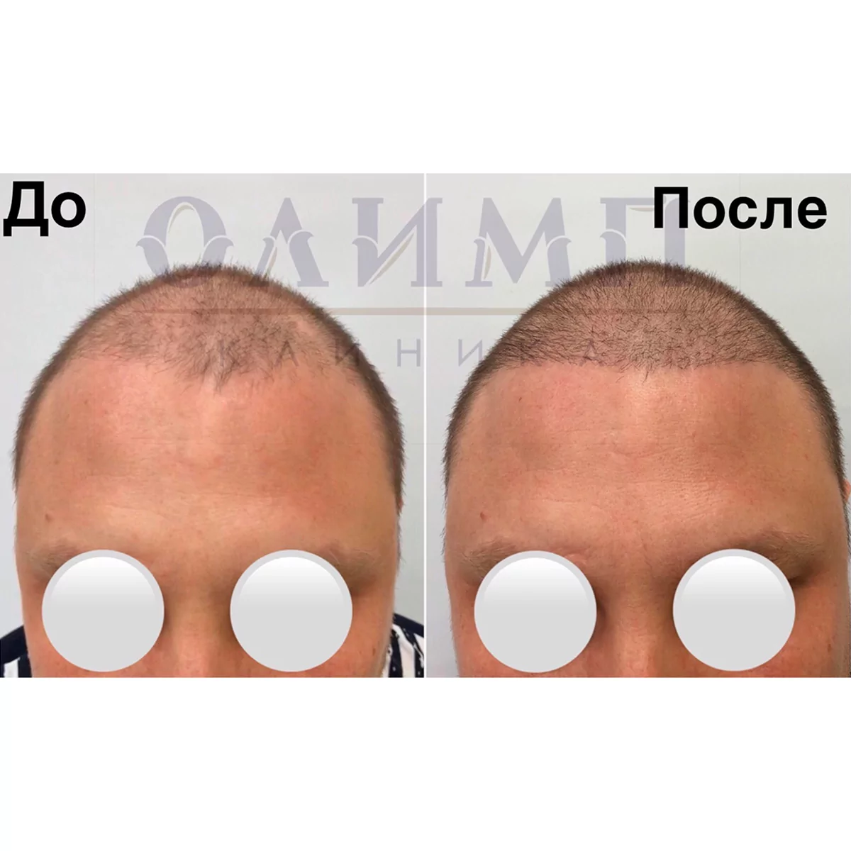пересадка волос в Волгограде фото до и после операции