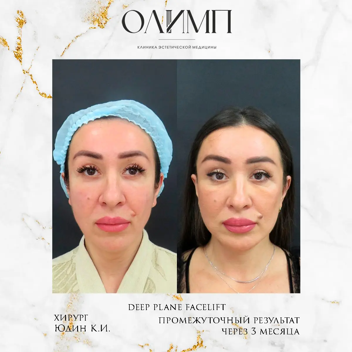 Результат операции — фотография 16