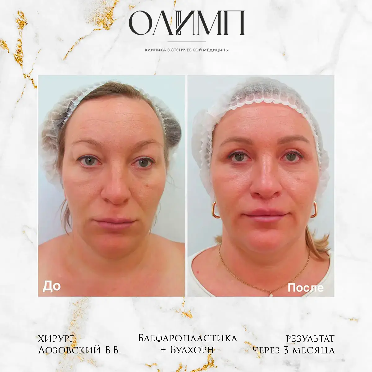 Блефаропластика 10