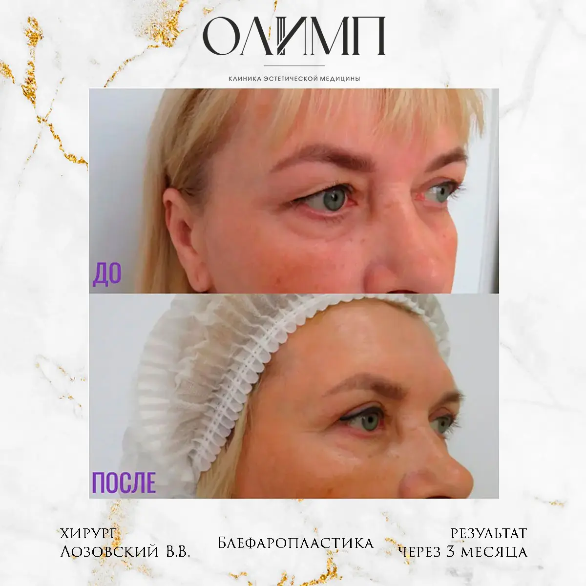 Блефаропластика 19