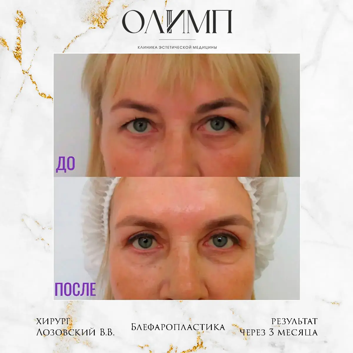 Блефаропластика 20