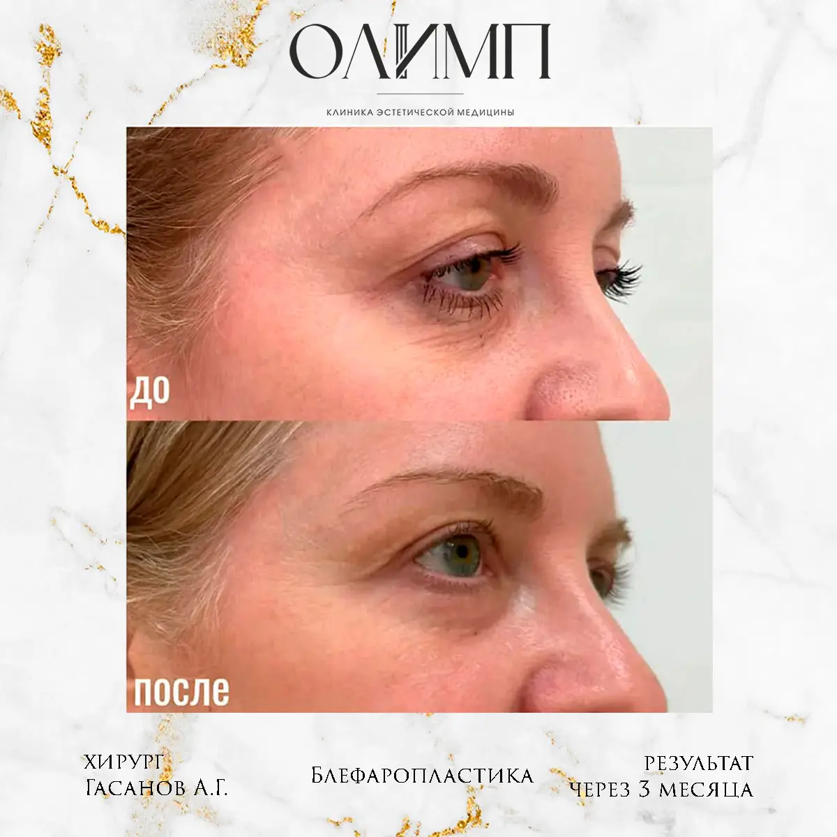 Блефаропластика 22