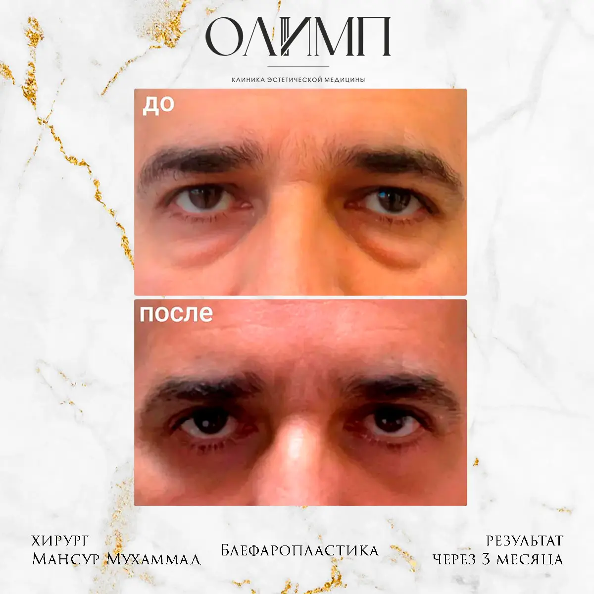 Блефаропластика 27