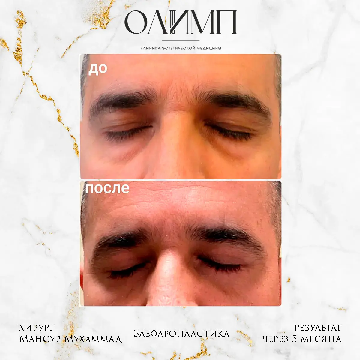 Блефаропластика 28
