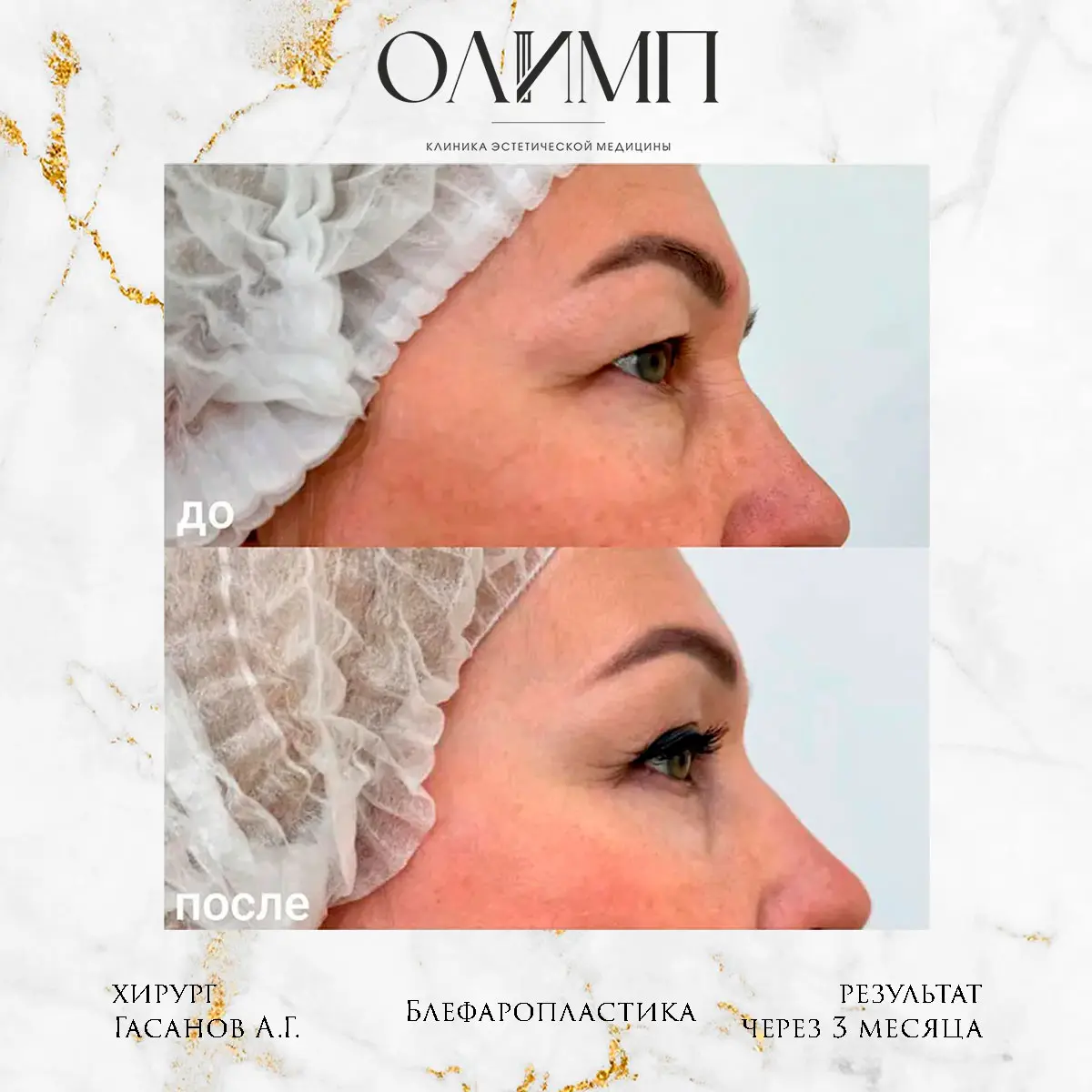 Блефаропластика 33