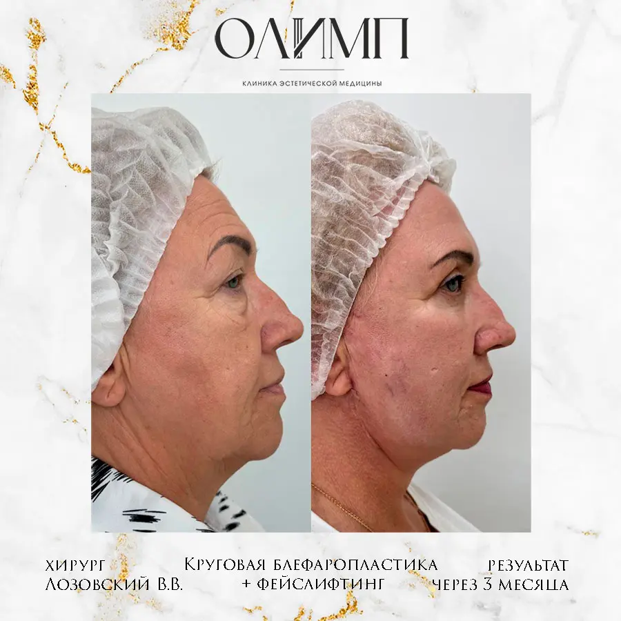 Блефаропластика 35