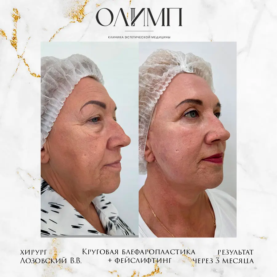 Блефаропластика 36
