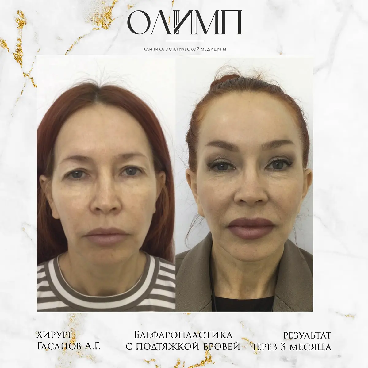 Блефаропластика 57