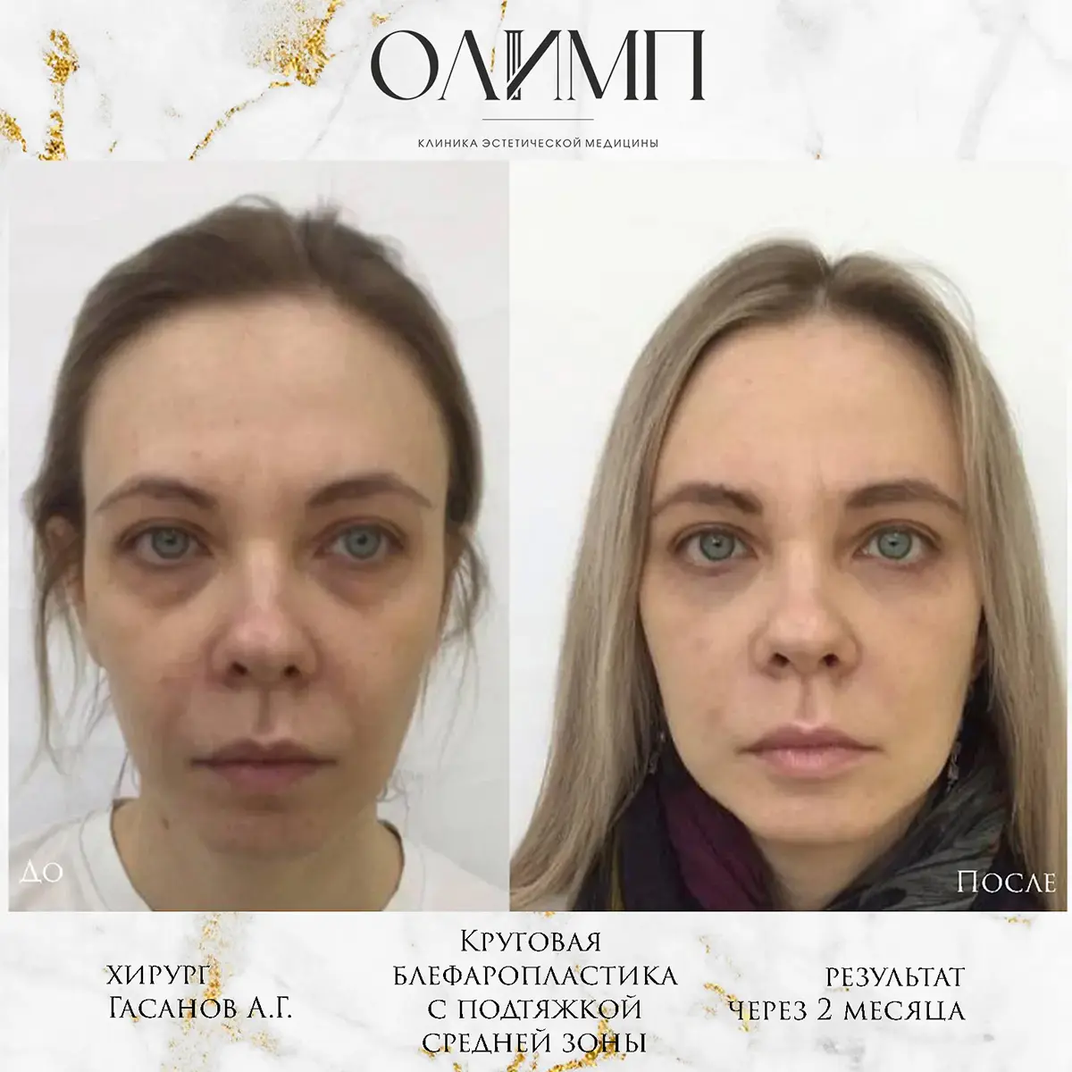 Блефаропластика 58