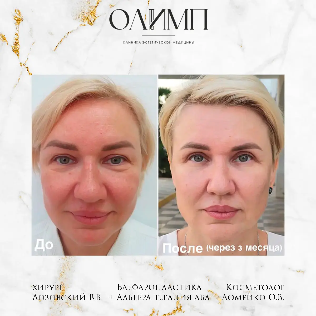 Блефаропластика 9