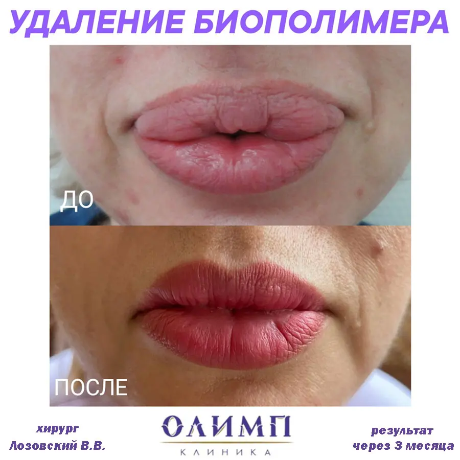 Хейлопластика 1
