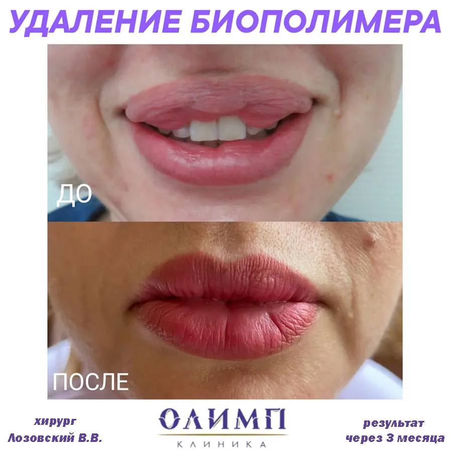 Хейлопластика 2