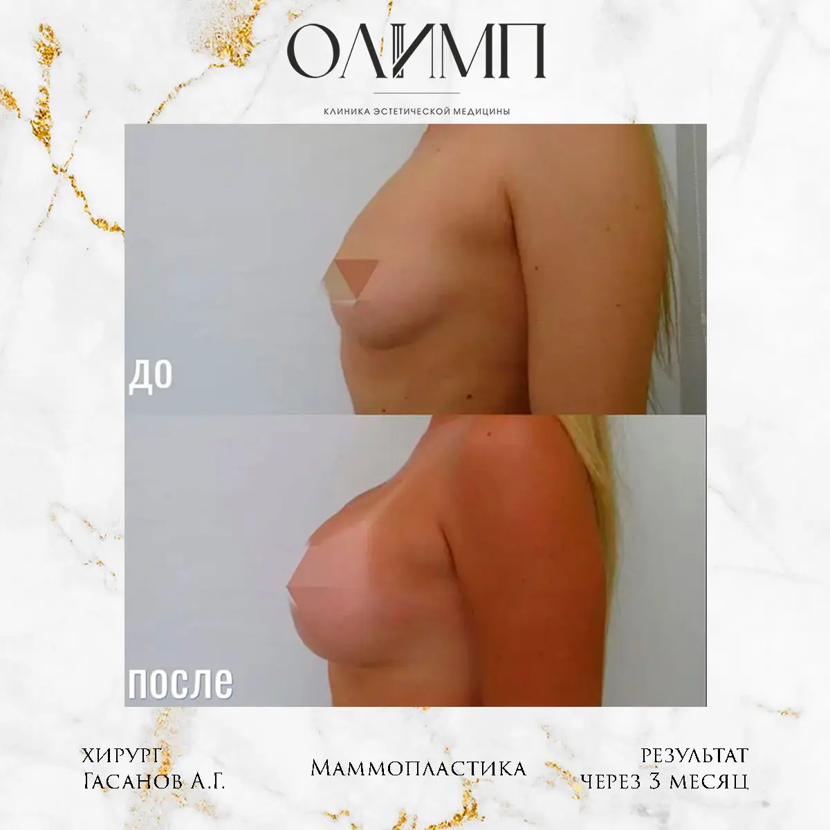 Маммопластика 21