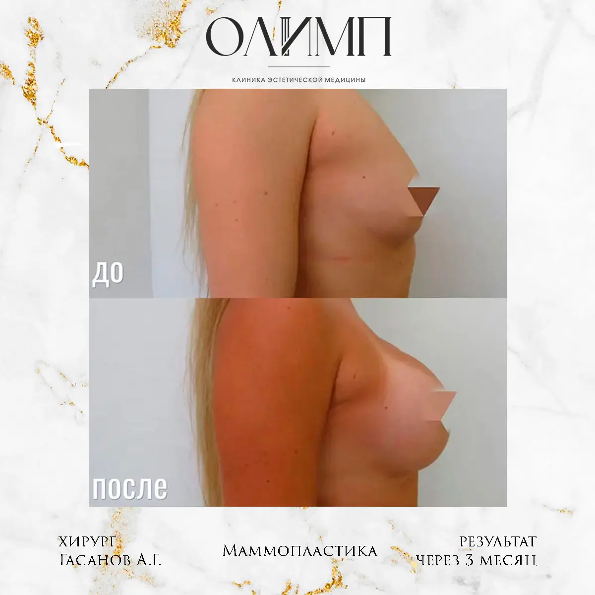 Маммопластика 22