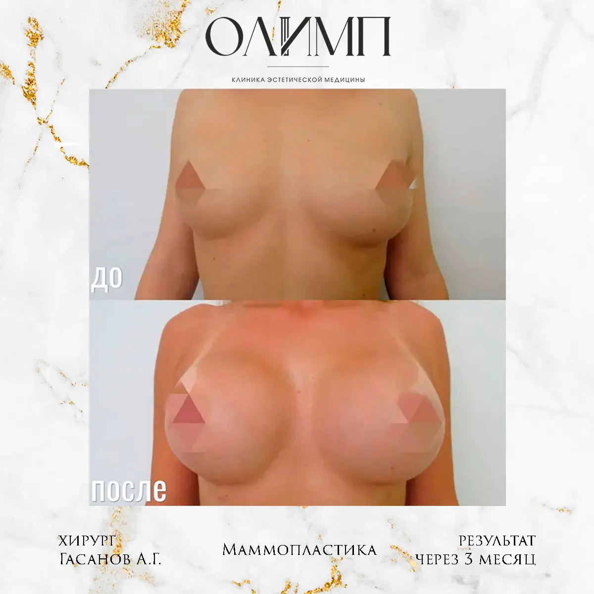 Маммопластика 23