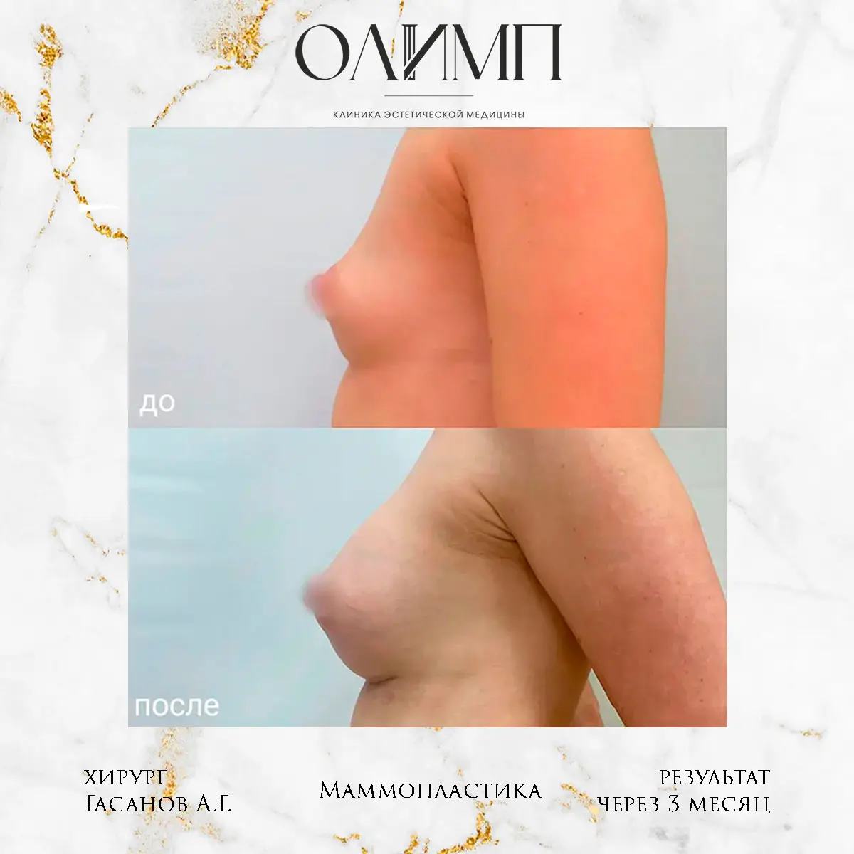 Маммопластика 24