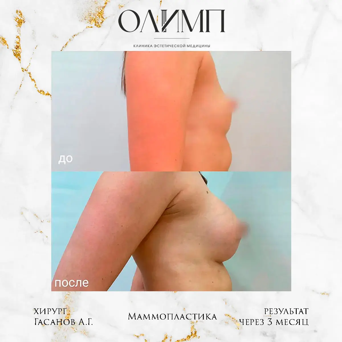 Маммопластика 25