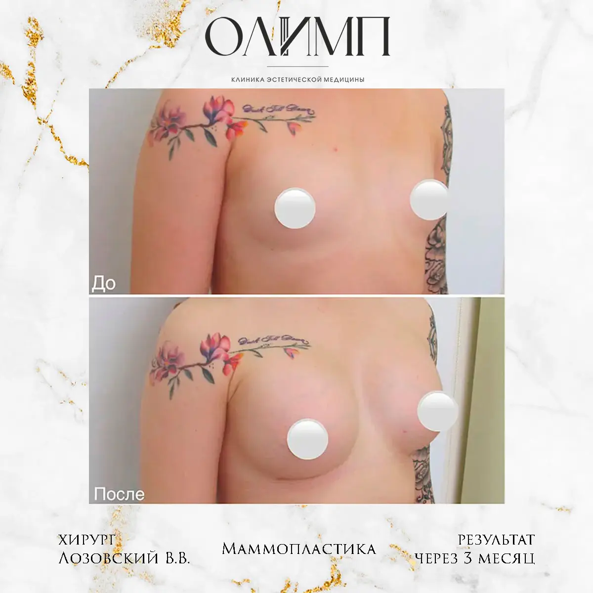 Маммопластика 4
