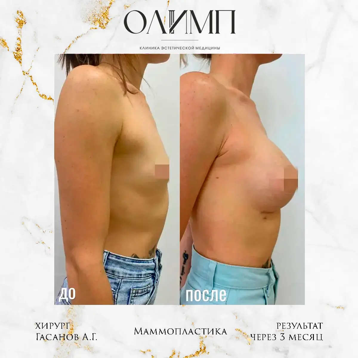Маммопластика 28