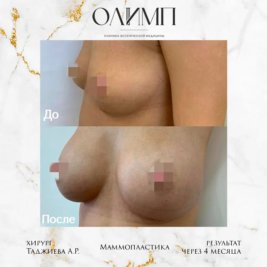 Маммопластика 52