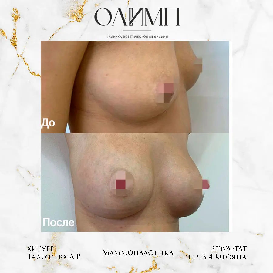 Маммопластика 53