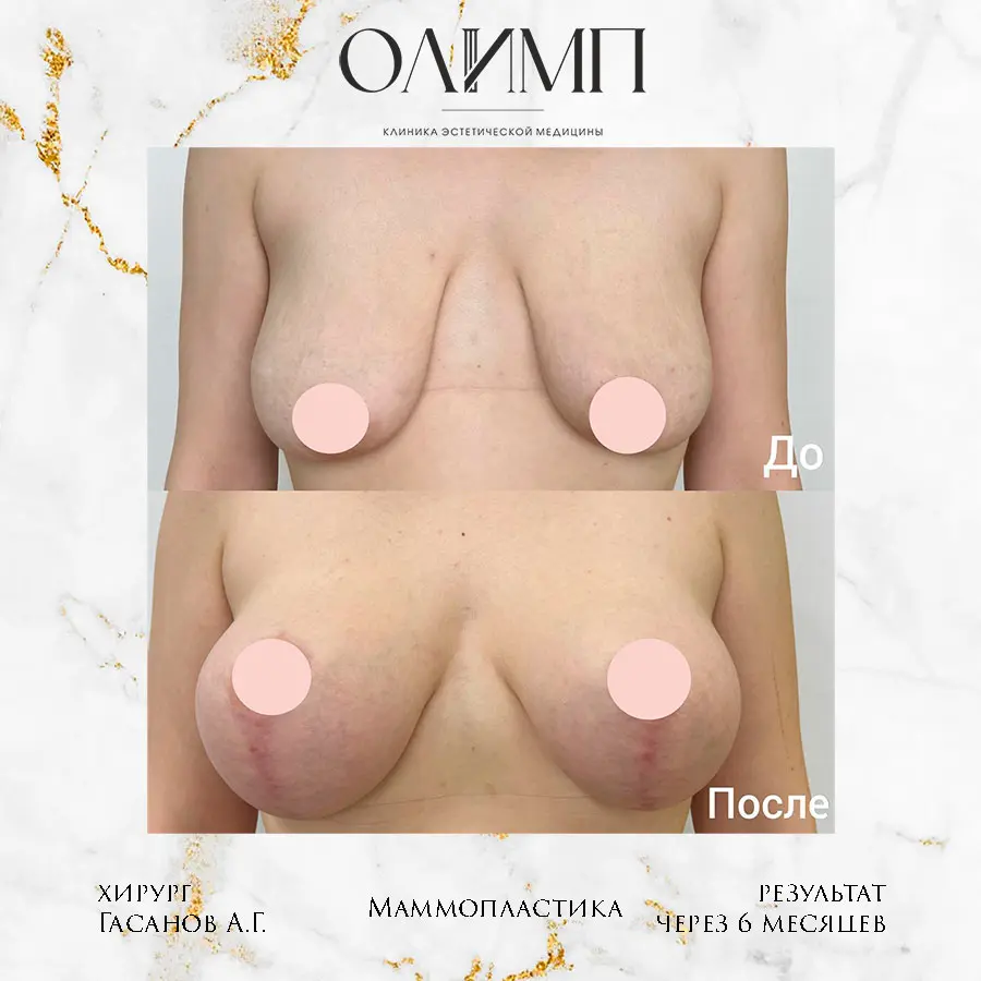 Маммопластика 54
