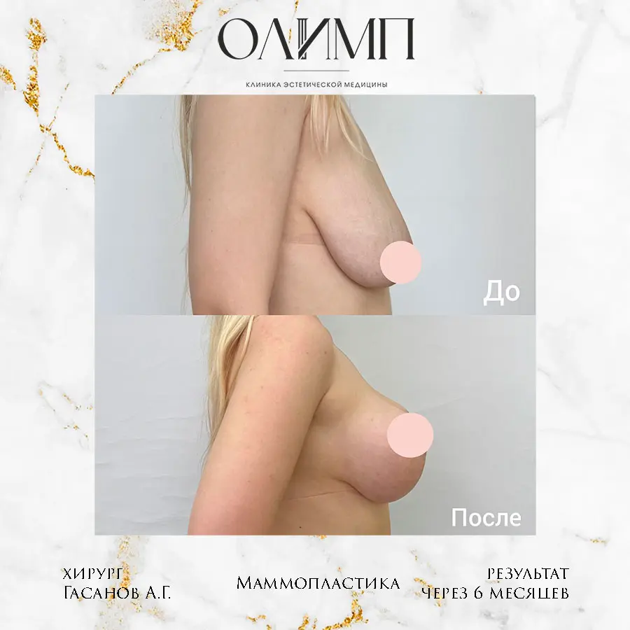 Маммопластика 55