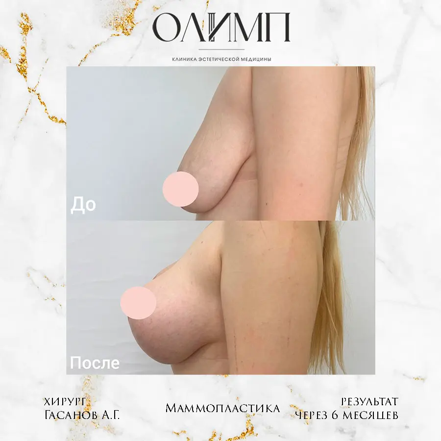Маммопластика 56