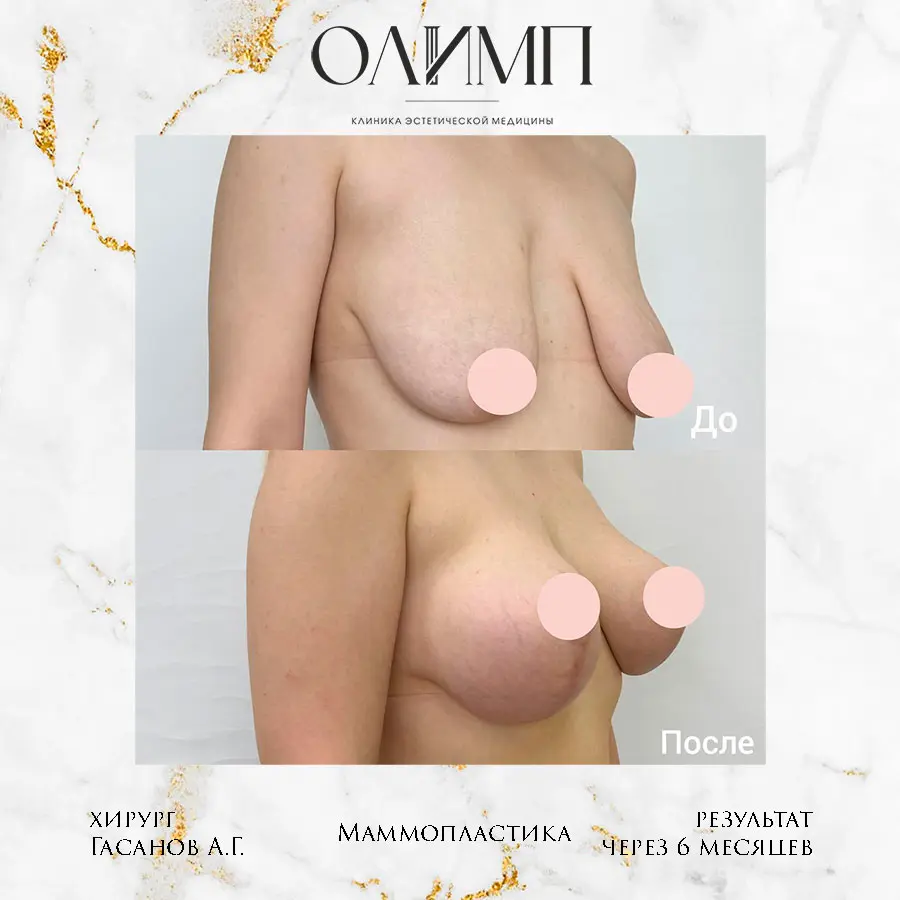 Маммопластика 58