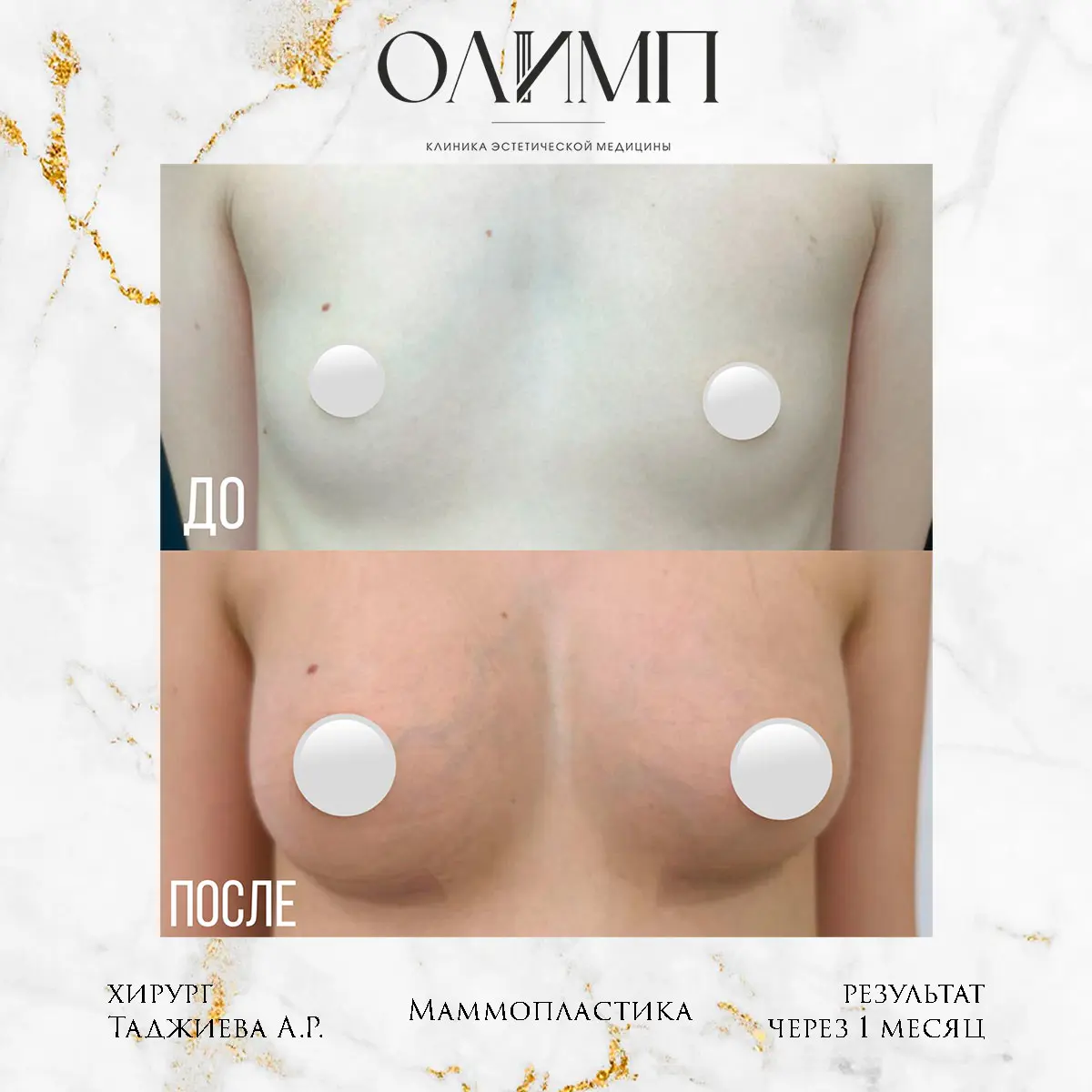 Маммопластика 59