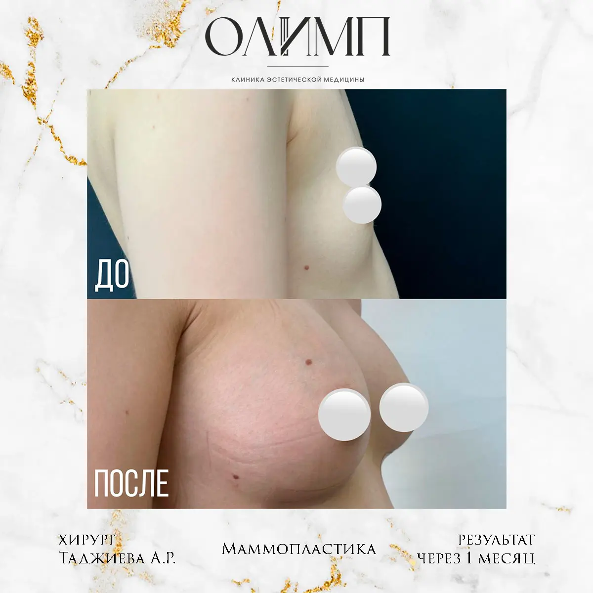 Маммопластика 60