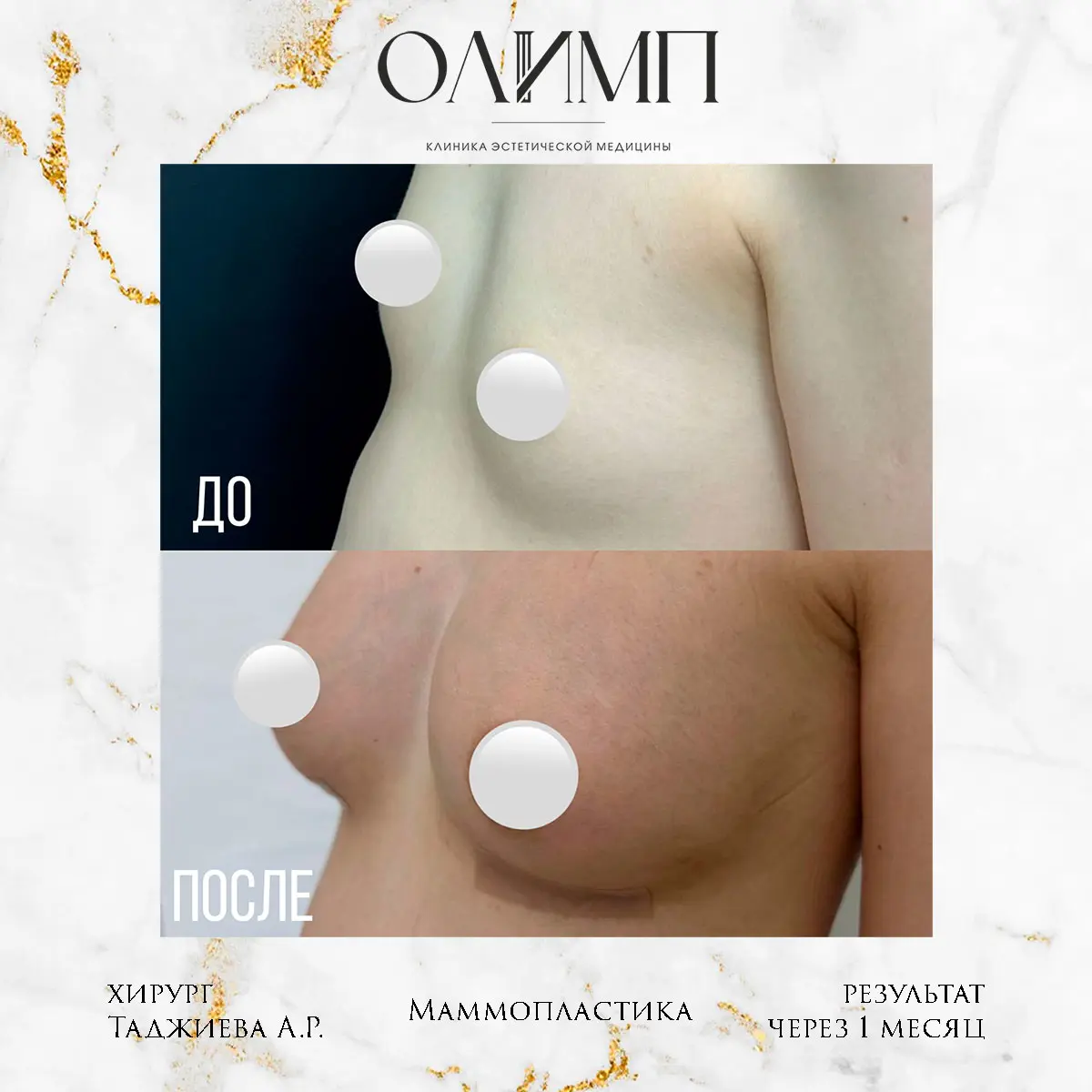 Маммопластика 61