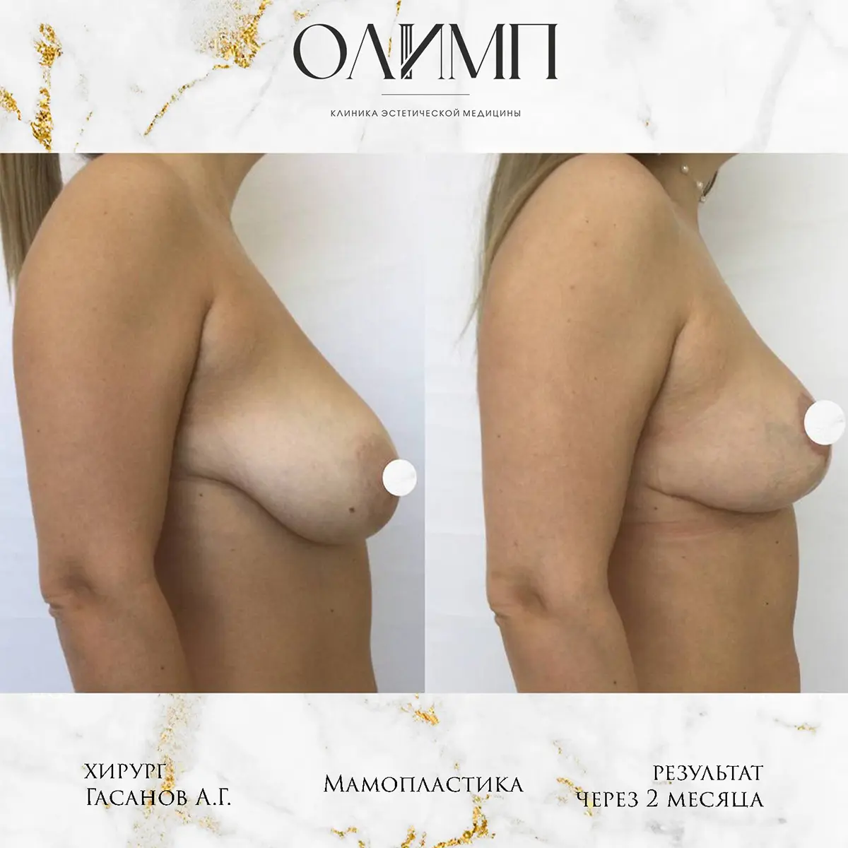 Маммопластика 70