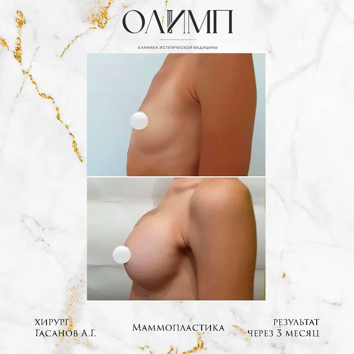 Маммопластика 9