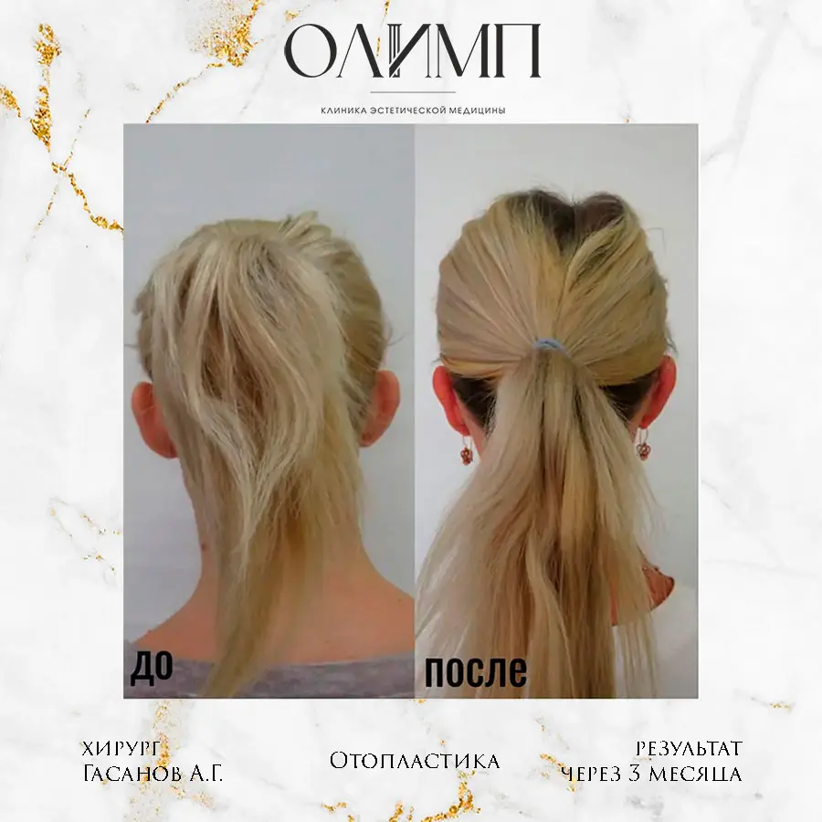 Отопластика 1