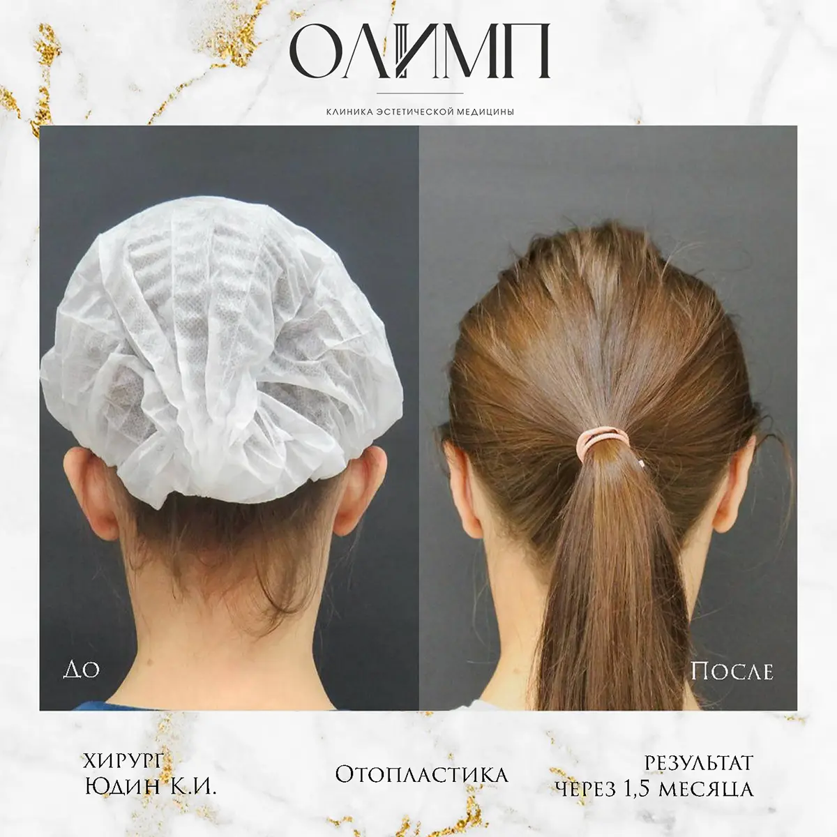 Отопластика 5