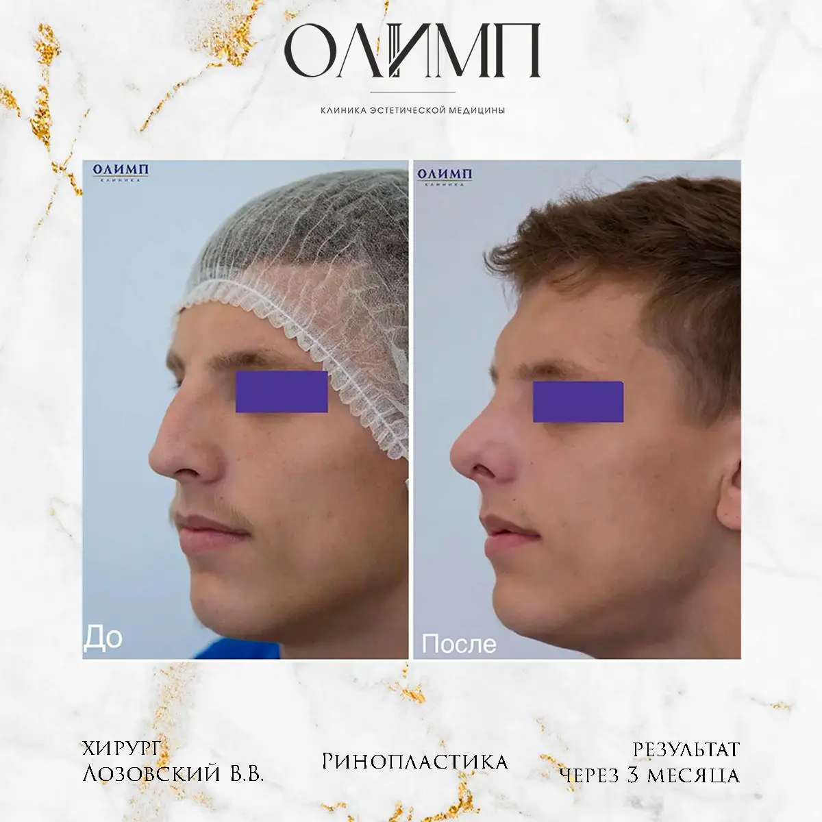 Ринопластика 12