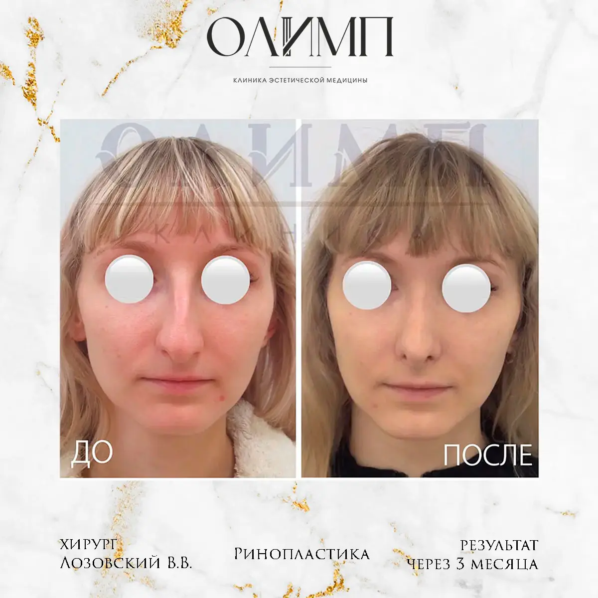 Ринопластика 15