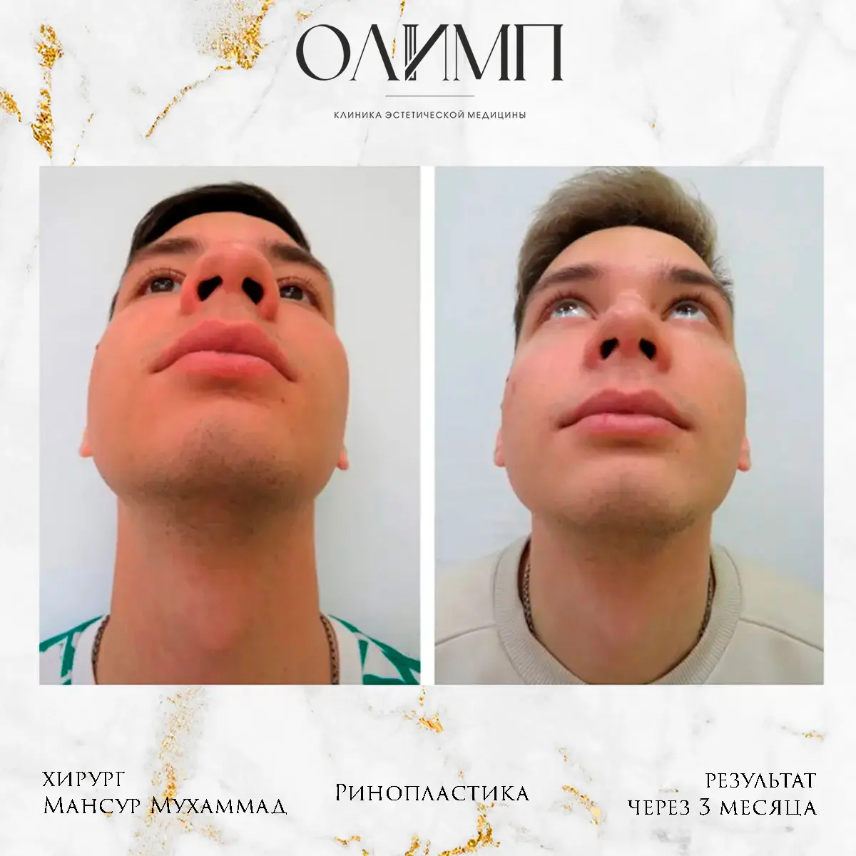 Ринопластика 25