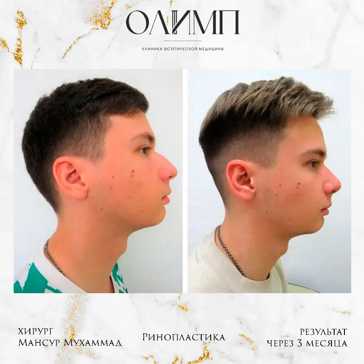 Ринопластика 26