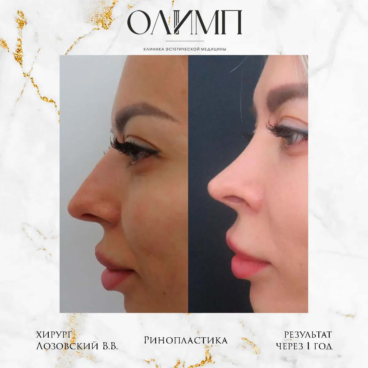Ринопластика 28