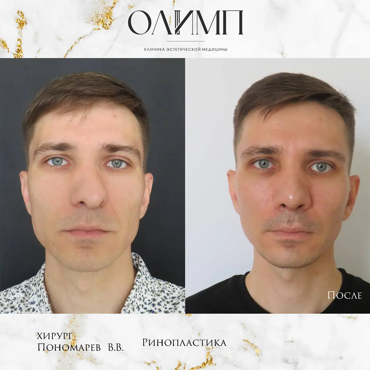 Ринопластика 27
