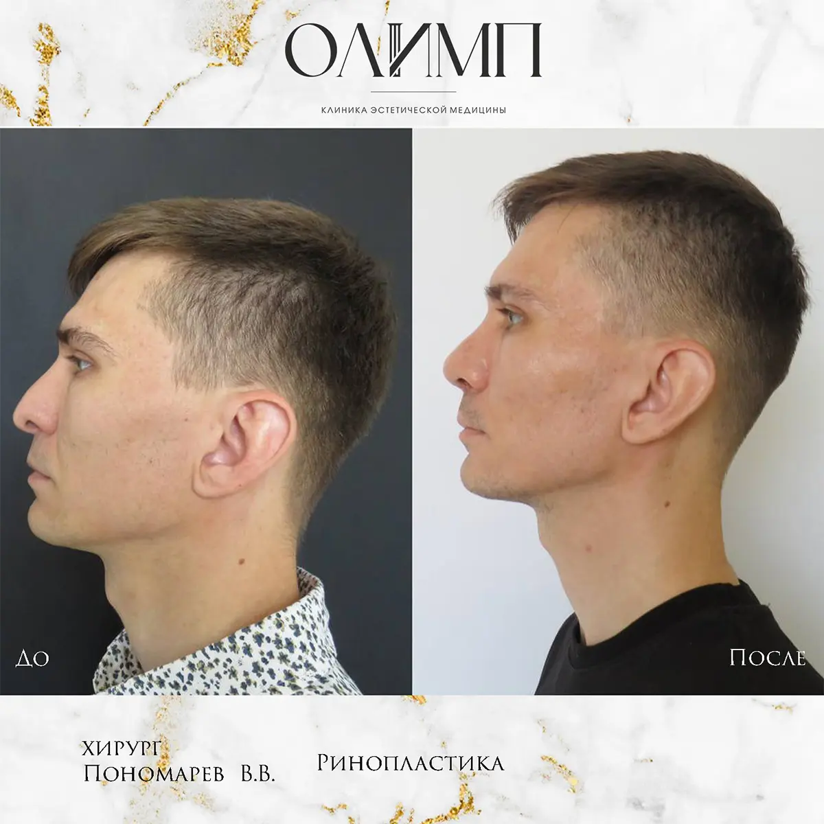 Ринопластика 28