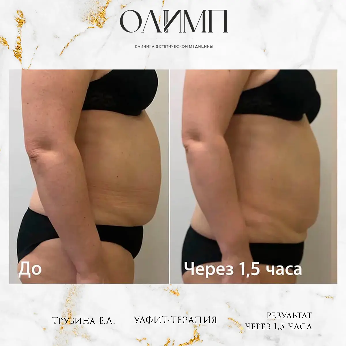 УЛФИТ терапия 13