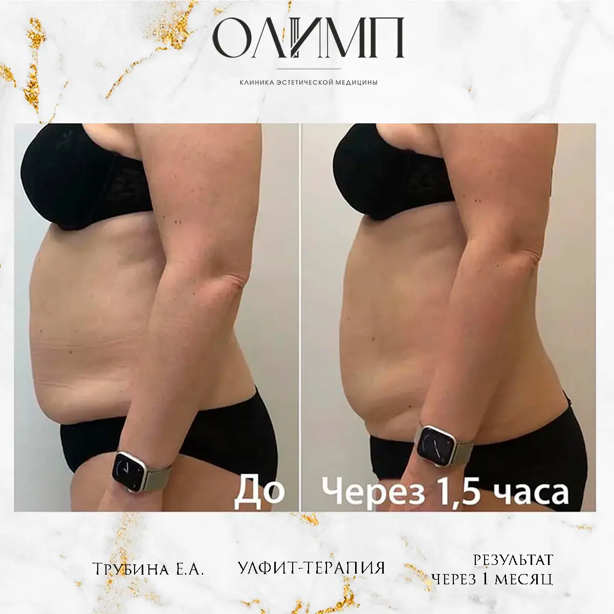 УЛФИТ терапия 14