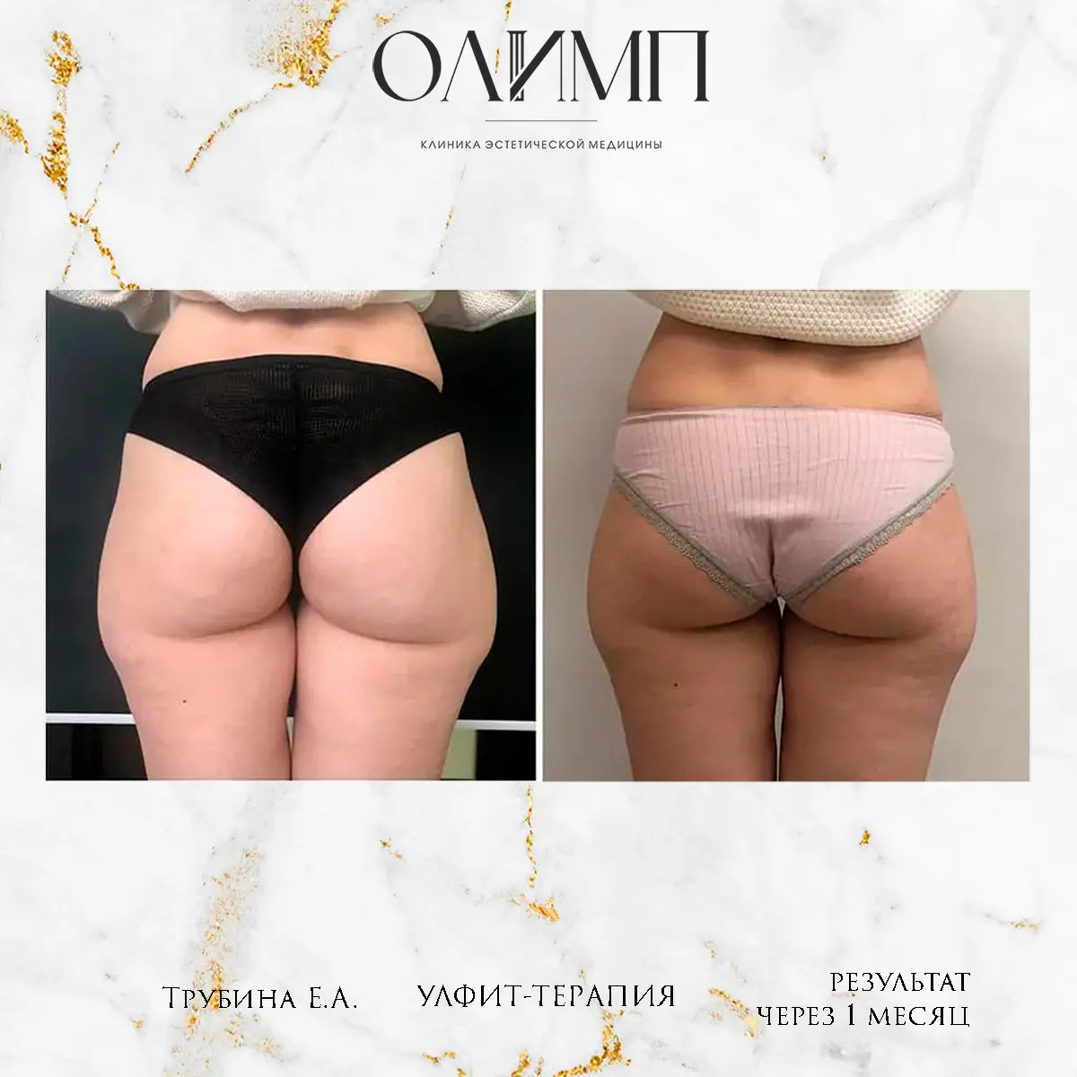 УЛФИТ терапия 5